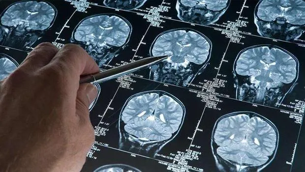 Alzheimer'da yeni umut: Erken evrede teşhisi mümkün kılacak kan testi ABD'de onaylandı